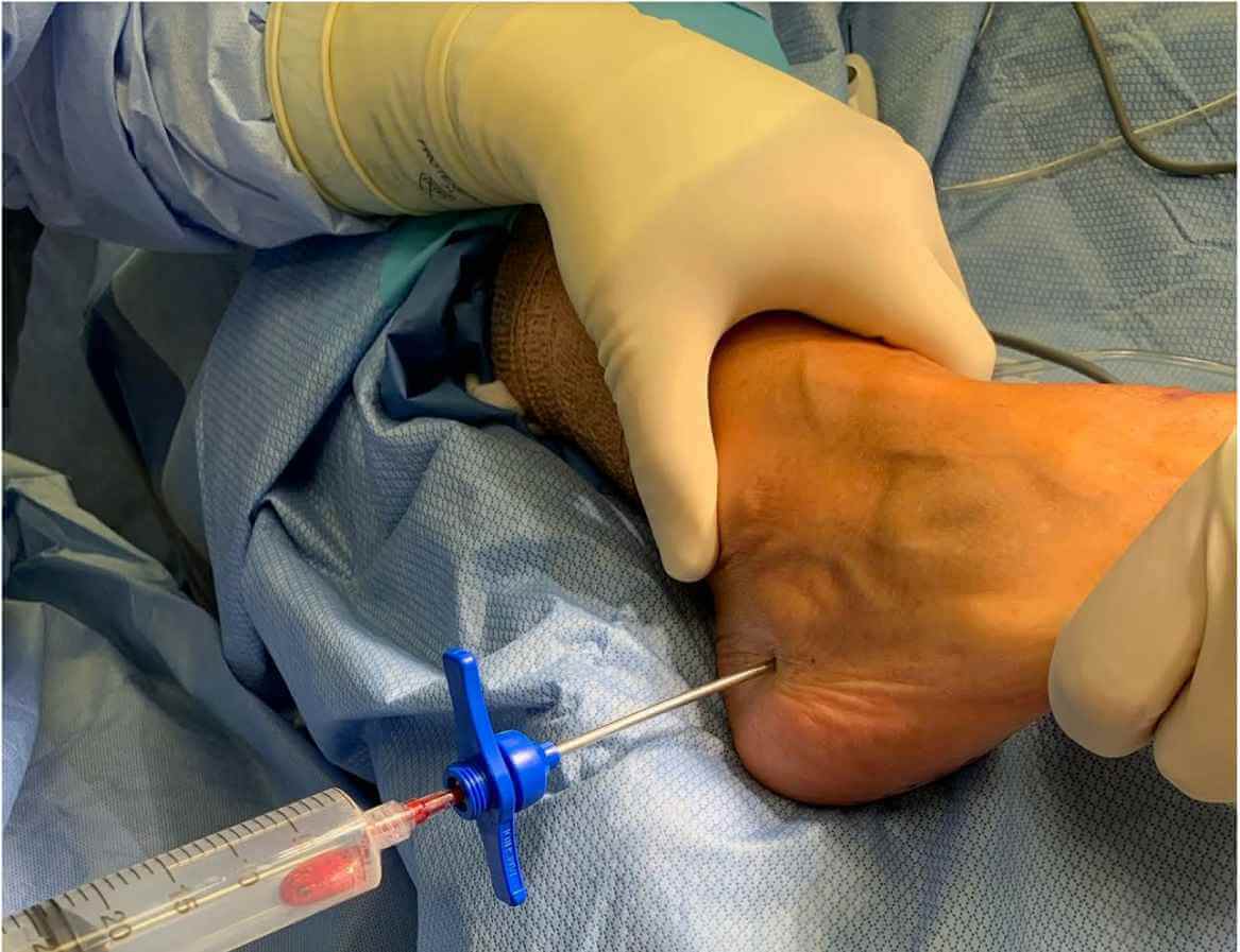 در این روش، جراحی با استفاده از دوربین بسیار نازک (اندوسکوپ) و ابزارهای مخصوص از طریق دو برش کوچک (کمتر از یک سانتی‌متر) در اطراف پاشنه انجام می‌شود