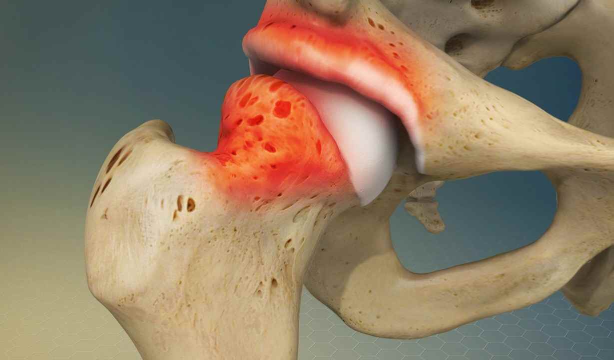 آرتروز لگن