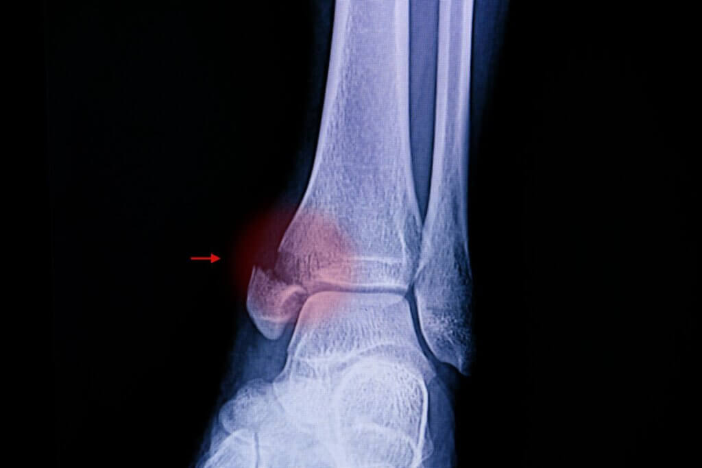 عکس رادیولوژی شکستگی مچ پا