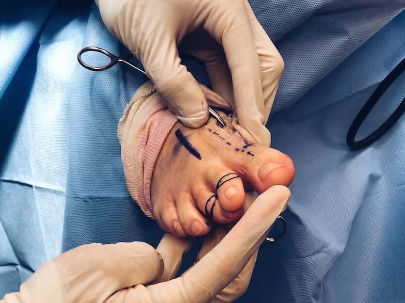 مراقبت بعد از عمل هالوکس والگوس
