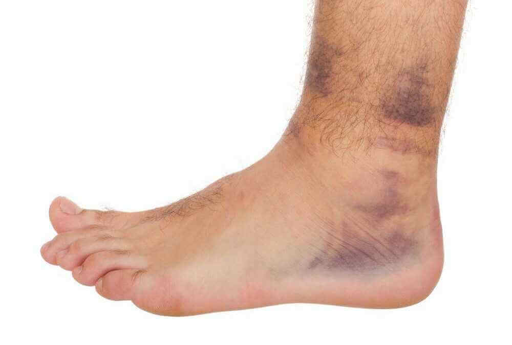 عکس و علائم رباط پاره شده