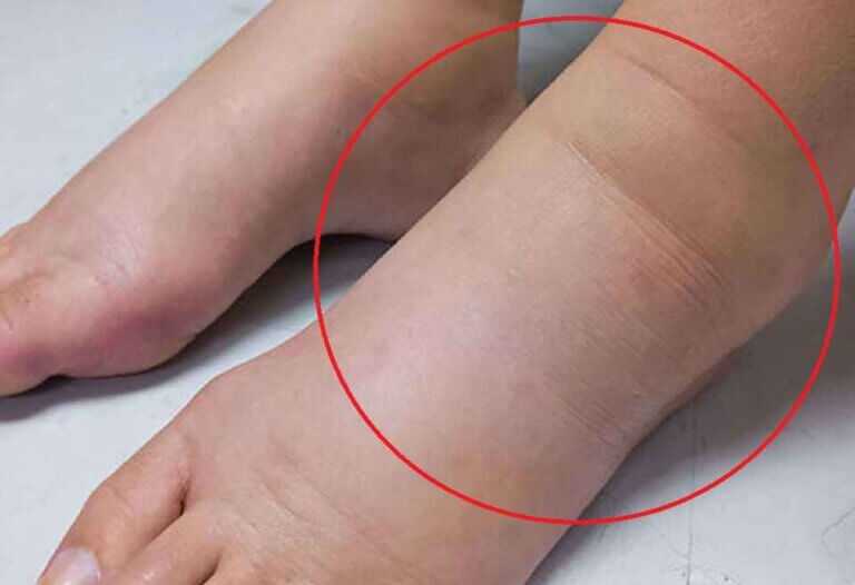 ورم مچ پا بدون درد به دلیل آسیب دیدگی