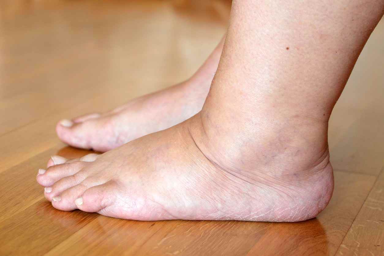 علت ورم مچ پا بدون
