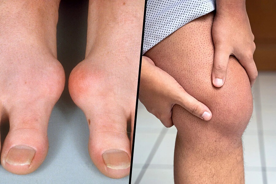 علائم نقرس در زنان