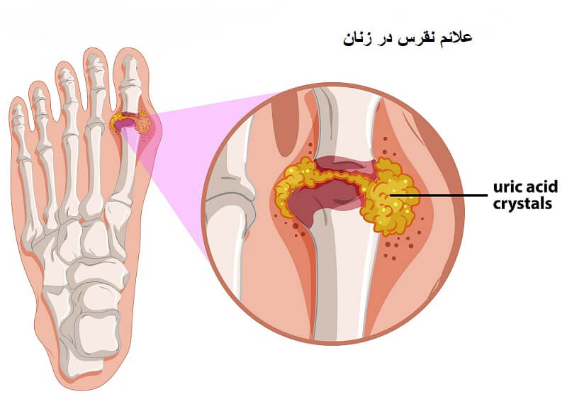 نقرس در زنان چه علائمی دارد