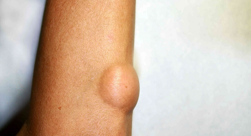 توده در پاها