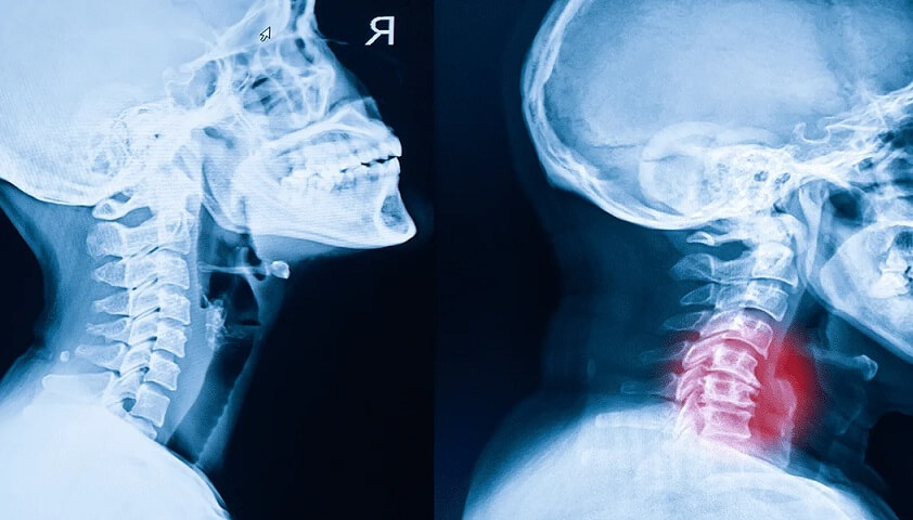 عکس آرتروز گردن