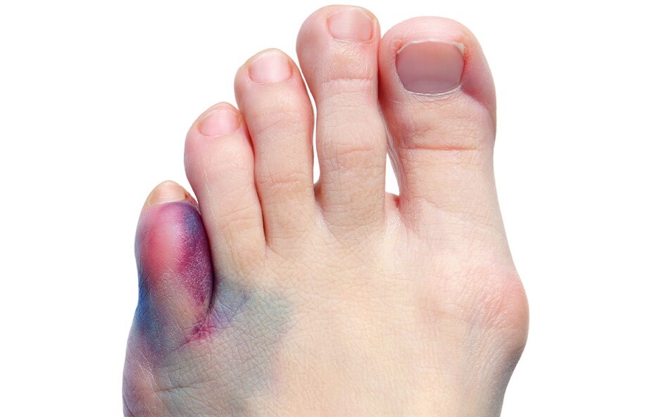 شکستگی انگشت کوچک پا