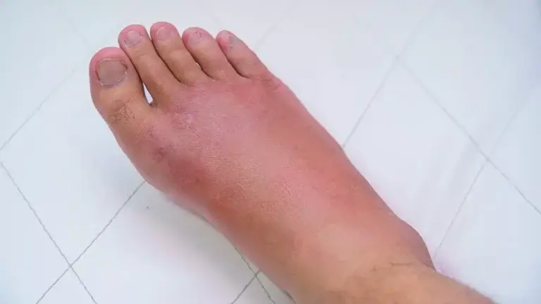 مچ پای راست