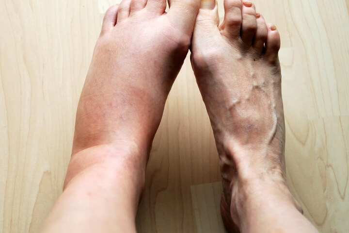 ایا ورم مچ پا خطرناکه