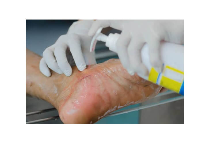 جلوگیری از زخم پای دیابتی